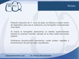 Relato
www.dentometric.com Dr. Enrique Sierra Rosales
Paciente masculino de 11 años de edad, es referido a nuestro centro
de diagnóstico para que le realicemos una tomografía computarizada
cone beam.
Al revisar la tomografía observamos un dientes supernumerario
retenido en posición invertida, ubicado en la línea media del maxilar
superior
Graficamos reconstrucción panorámica, cortes axiales, sagitales y
reconstrucción 3D para su mejor visualización.