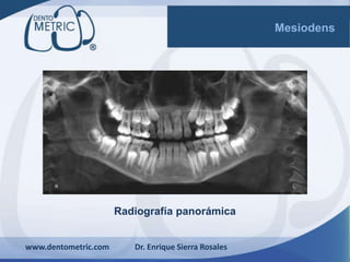 Radiografía panorámica
www.dentometric.com Dr. Enrique Sierra Rosales
Mesiodens