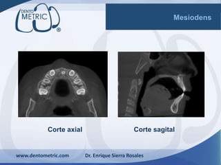 Corte axial
www.dentometric.com Dr. Enrique Sierra Rosales
Mesiodens
Corte sagital