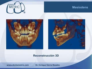 Reconstrucción 3D
www.dentometric.com Dr. Enrique Sierra Rosales
Mesiodens