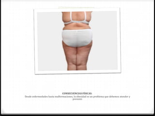 CONSECUENCIAS FÍSICAS:
Desde enfermedades hasta malformaciones, la obesidad es un problema que debemos atender y
prevenir.
 