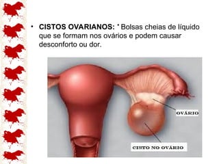 .
• CISTOS OVARIANOS: Bolsas cheias de líquido
que se formam nos ovários e podem causar
desconforto ou dor.
 
