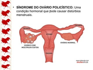 .
• SÍNDROME DO OVÁRIO POLICÍSTICO: Uma
condição hormonal que pode causar distúrbios
menstruais.
 