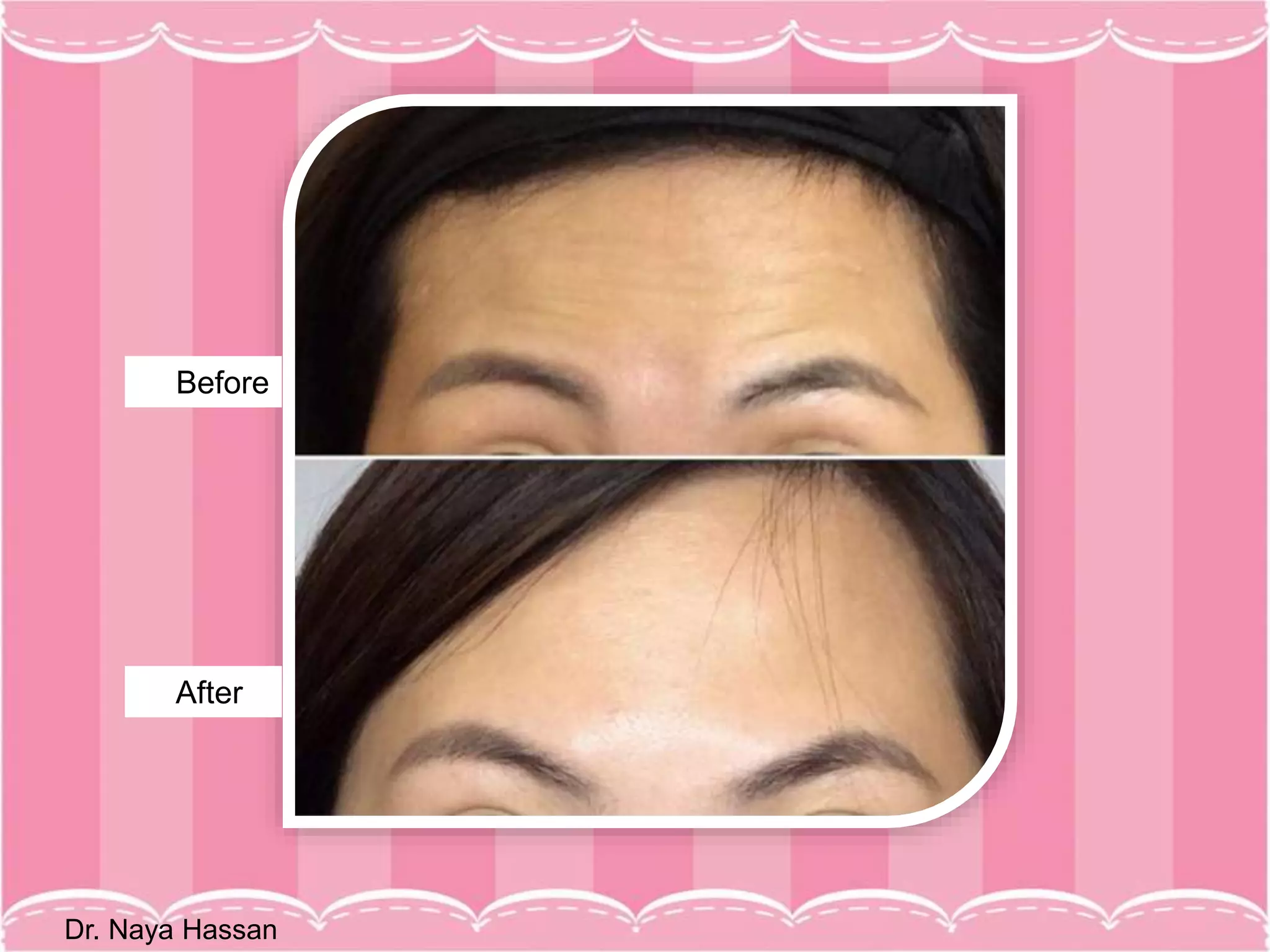 Mesobotox: a New Technique for Aesthetic Treatments | PPT