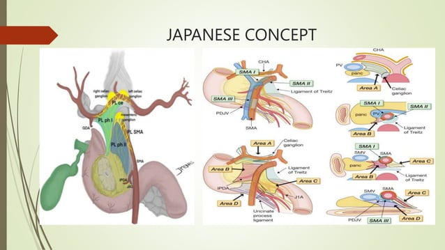 Management of MESOPANCREAS& TRIANGLE OPERATION.pptx