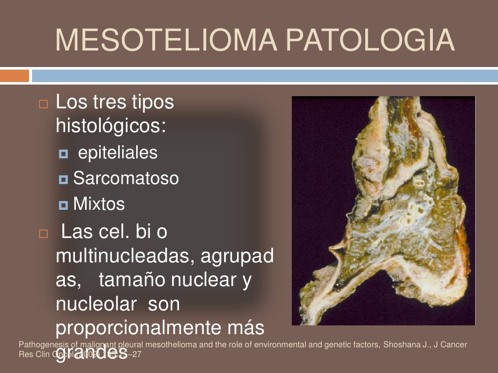 Mesotelioma
