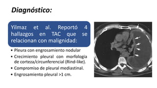 Yilmaz et al. Reportó 4
hallazgos en TAC que se
relacionan con malignidad:
• Pleura con engrosamiento nodular
• Crecimiento pleural con morfologia
de corteza/circunferencial (Rind-like).
• Compromiso de pleural mediastinal.
• Engrosamiento pleural >1 cm.
Diagnóstico:
 