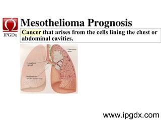 Cancer that arises from the cells lining the chest or abdominal cavities.  Mesothelioma Prognosis  www.ipgdx.com 