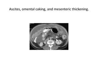 Ascites, omental caking, and mesenteric thickening.
 