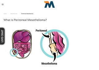 Home / Mesothelioma / Peritoneal Mesothelioma
What is Peritoneal Mesothelioma?
LIVECHAT
 