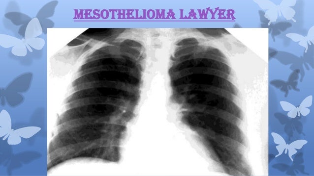 Mesothelioma lawyer