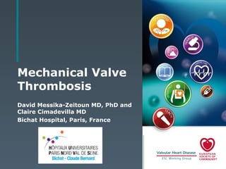 Mechanical Valve
Thrombosis
David Messika-Zeitoun MD, PhD and
Claire Cimadevilla MD
Bichat Hospital, Paris, France
 