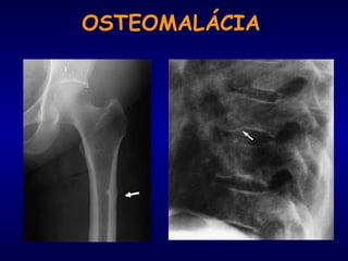 OSTEOMALÁCIA
 