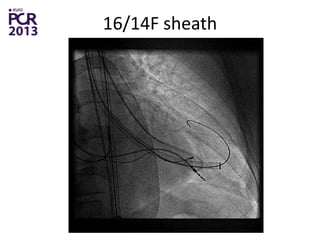 Meta analysis of percutaneous ventricular restoration (pvr) therapy ...