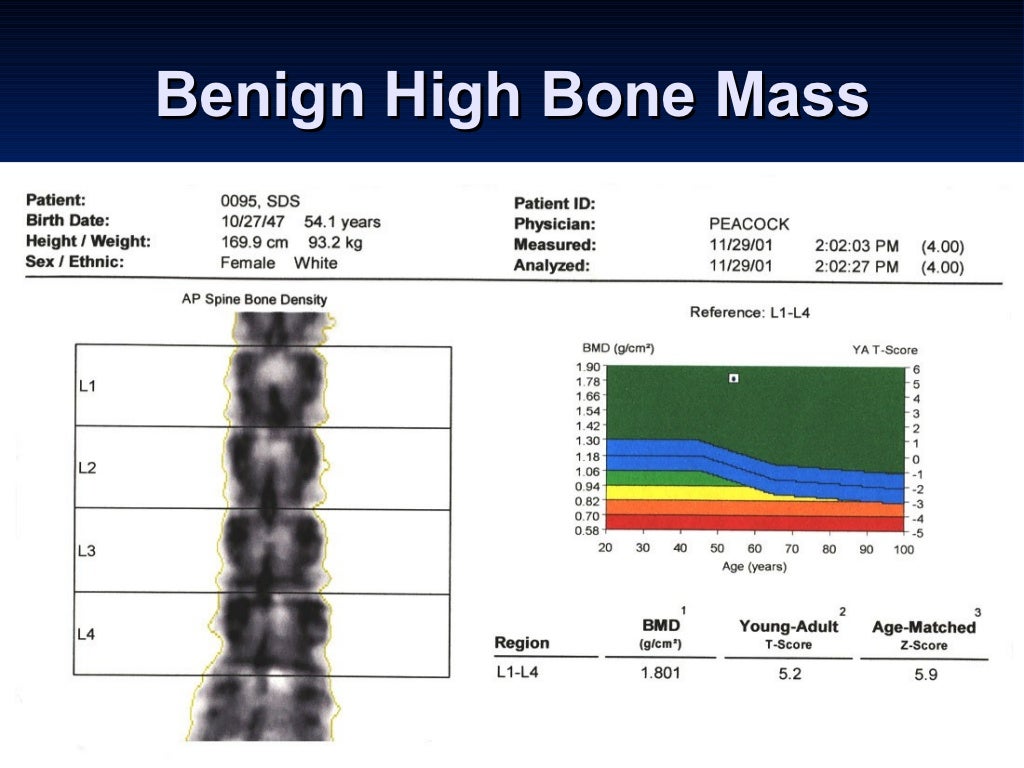 Metabolic Bone Disease