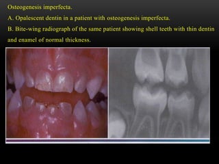 Osteogenesis imperfecta.
A. Opalescent dentin in a patient with osteogenesis imperfecta.
B. Bite-wing radiograph of the same patient showing shell teeth with thin dentin
and enamel of normal thickness.
 