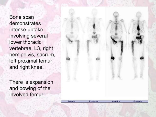 Metabolic Bone Diseases