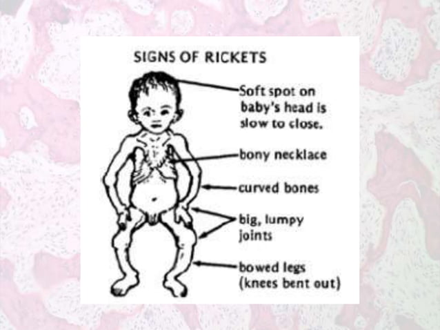 Metabolic Bone Diseases