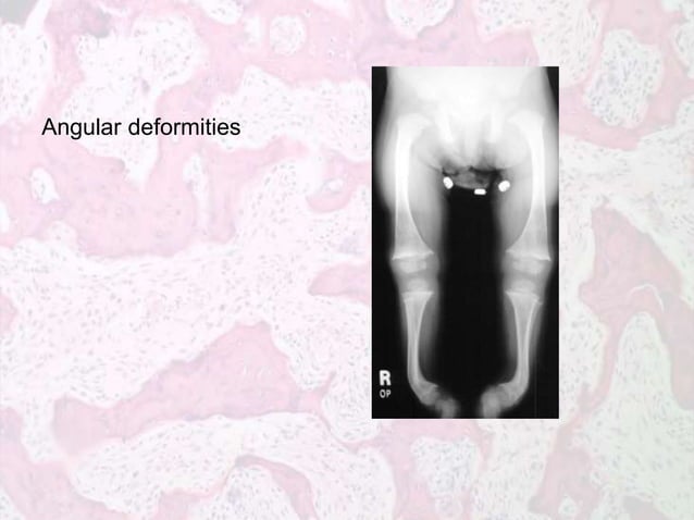 Metabolic Bone Diseases