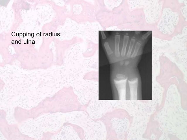 Metabolic Bone Diseases