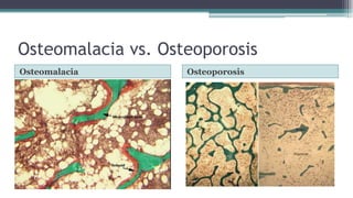 Osteomalacia vs. Osteoporosis
Osteomalacia Osteoporosis
 