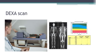 DEXA scan
 