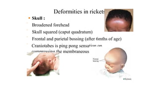 METABOLIC BONE DISEASES FINnAL.PPTX.pptx