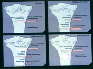 C Rickets Metabolic Bone disorders and rickets and osteomalacia | PPTX