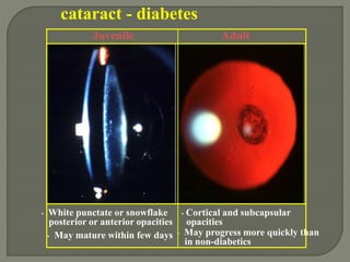 cataract - diabetes
Juvenile
• White punctate or snowflake
posterior or anterior opacities
• May mature within few days
Adult
• Cortical and subcapsular
opacities
• May progress more quickly than
in non-diabetics
 
