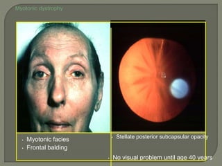 Myotonic dystrophy
• Myotonic facies
• Frontal balding
• Stellate posterior subcapsular opacity
• No visual problem until age 40 years
 