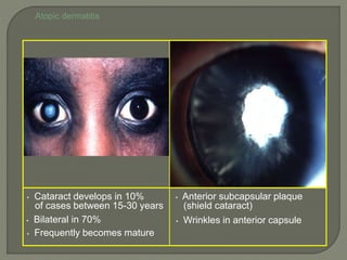 Atopic dermatitis
• Cataract develops in 10%
of cases between 15-30 years
• Bilateral in 70%
• Frequently becomes mature
• Anterior subcapsular plaque
(shield cataract)
• Wrinkles in anterior capsule
 