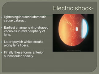  lightening/industrial/domestic
cause cataract.
 Earliest change is ring-shaped
vacuoles in mid periphery of
lens.
 Later grayish white streaks
along lens fibers.
 Finally these forms anterior
subcapsular opacity.
 
