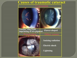Causes of traumatic cataract
Penetration
Concussion
‘Vossius’ ring from
imprinting of iris pigment Flower-shaped
• Ionizing radiation
• Electric shock
• Lightning
Other causes
 