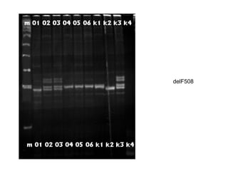 delF508
 