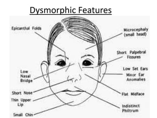 Dysmorphic Features
 