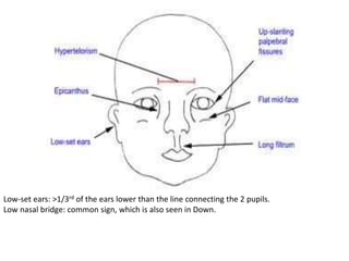 Low-set ears: >1/3rd of the ears lower than the line connecting the 2 pupils.
Low nasal bridge: common sign, which is also seen in Down.
 