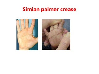Simian palmer crease
 