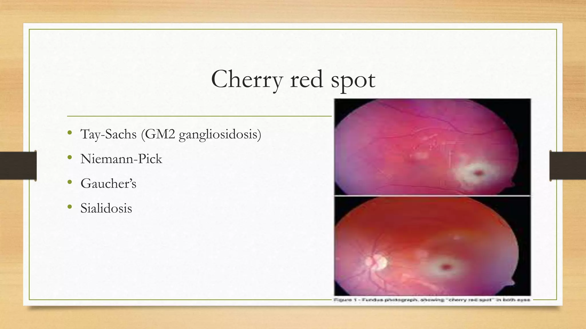 Cherry red spot
• Tay-Sachs (GM2 gangliosidosis)
• Niemann-Pick
• Gaucher’s
• Sialidosis
 
