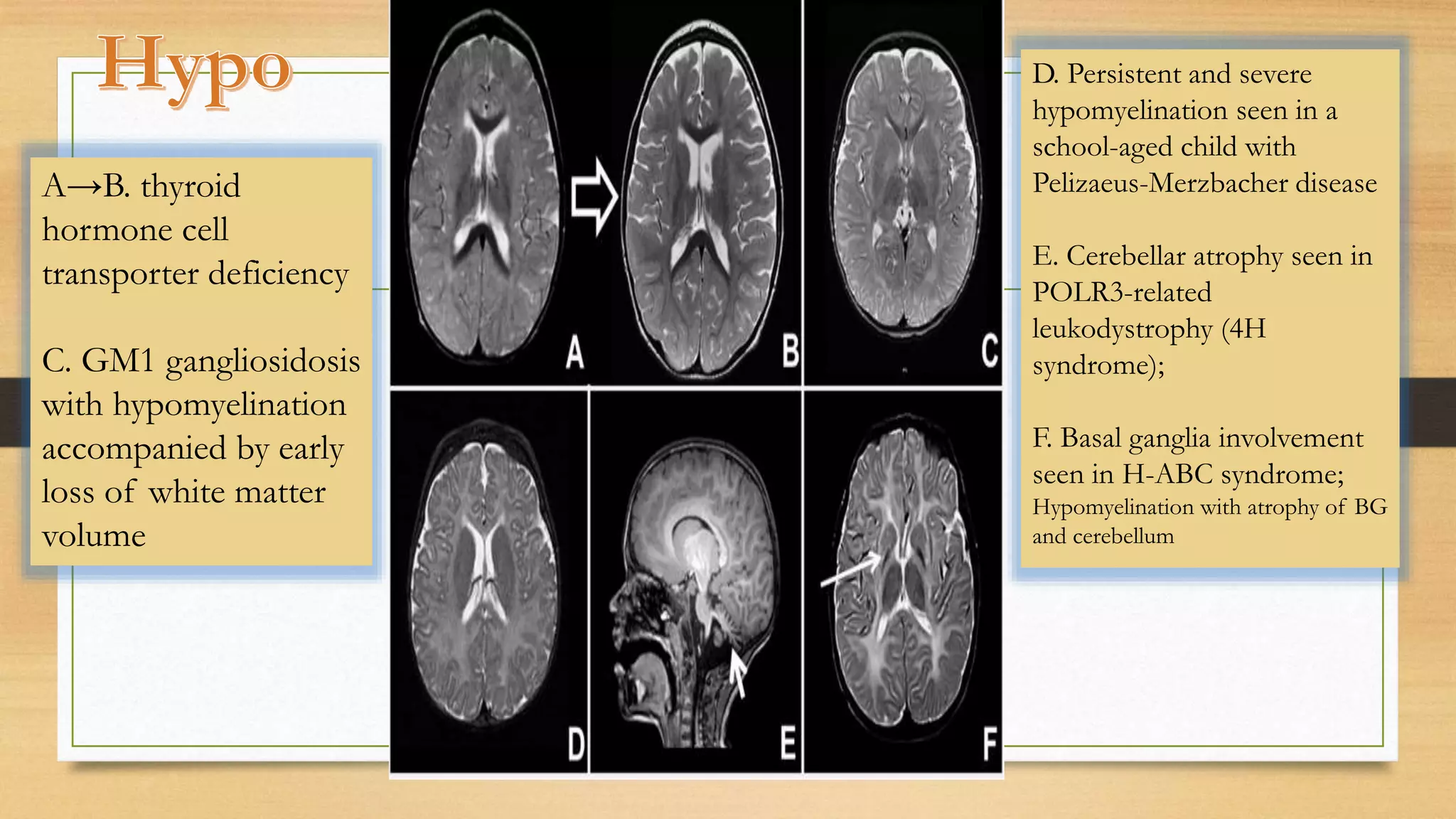 A→B. thyroid
hormone cell
transporter deficiency
C. GM1 gangliosidosis
with hypomyelination
accompanied by early
loss of white matter
volume
D. Persistent and severe
hypomyelination seen in a
school-aged child with
Pelizaeus-Merzbacher disease
E. Cerebellar atrophy seen in
POLR3-related
leukodystrophy (4H
syndrome);
F. Basal ganglia involvement
seen in H-ABC syndrome;
Hypomyelination with atrophy of BG
and cerebellum
 