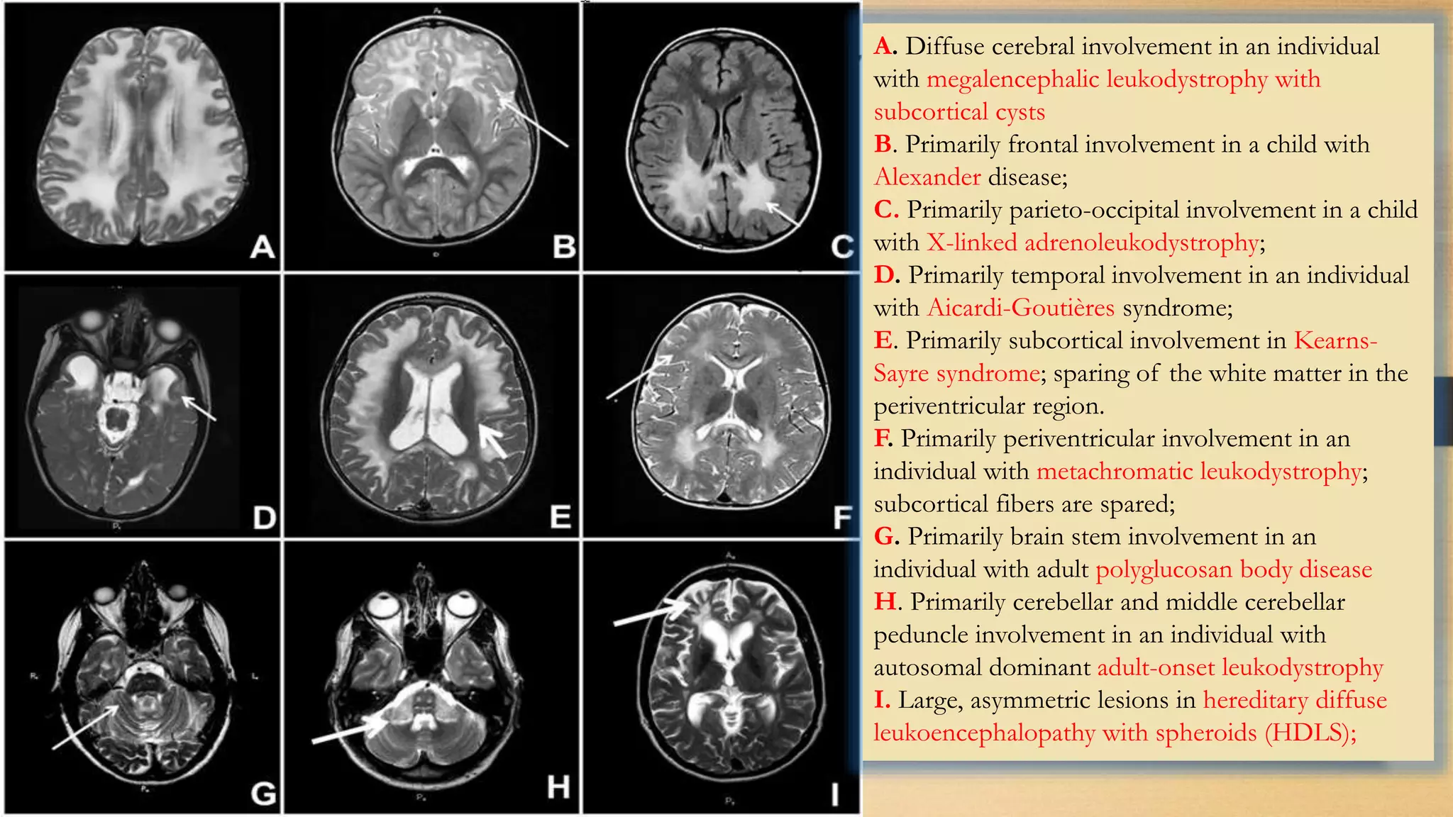 A. Diffuse cerebral involvement in an individual
with megalencephalic leukodystrophy with
subcortical cysts
B. Primarily frontal involvement in a child with
Alexander disease;
C. Primarily parieto-occipital involvement in a child
with X-linked adrenoleukodystrophy;
D. Primarily temporal involvement in an individual
with Aicardi-Goutières syndrome;
E. Primarily subcortical involvement in Kearns-
Sayre syndrome; sparing of the white matter in the
periventricular region.
F. Primarily periventricular involvement in an
individual with metachromatic leukodystrophy;
subcortical fibers are spared;
G. Primarily brain stem involvement in an
individual with adult polyglucosan body disease
H. Primarily cerebellar and middle cerebellar
peduncle involvement in an individual with
autosomal dominant adult-onset leukodystrophy
I. Large, asymmetric lesions in hereditary diffuse
leukoencephalopathy with spheroids (HDLS);
 