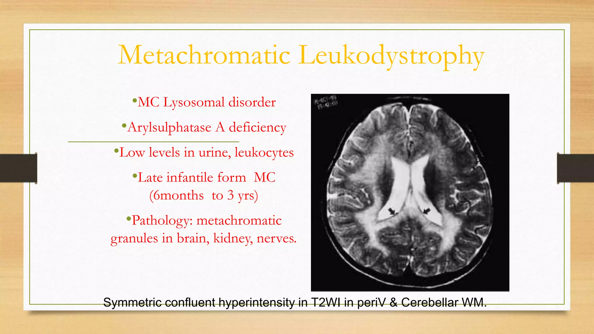 Metachromatic Leukodystrophy
•MC Lysosomal disorder
•Arylsulphatase A deficiency
•Low levels in urine, leukocytes
•Late infantile form MC
(6months to 3 yrs)
•Pathology: metachromatic
granules in brain, kidney, nerves.
Symmetric confluent hyperintensity in T2WI in periV & Cerebellar WM.
 