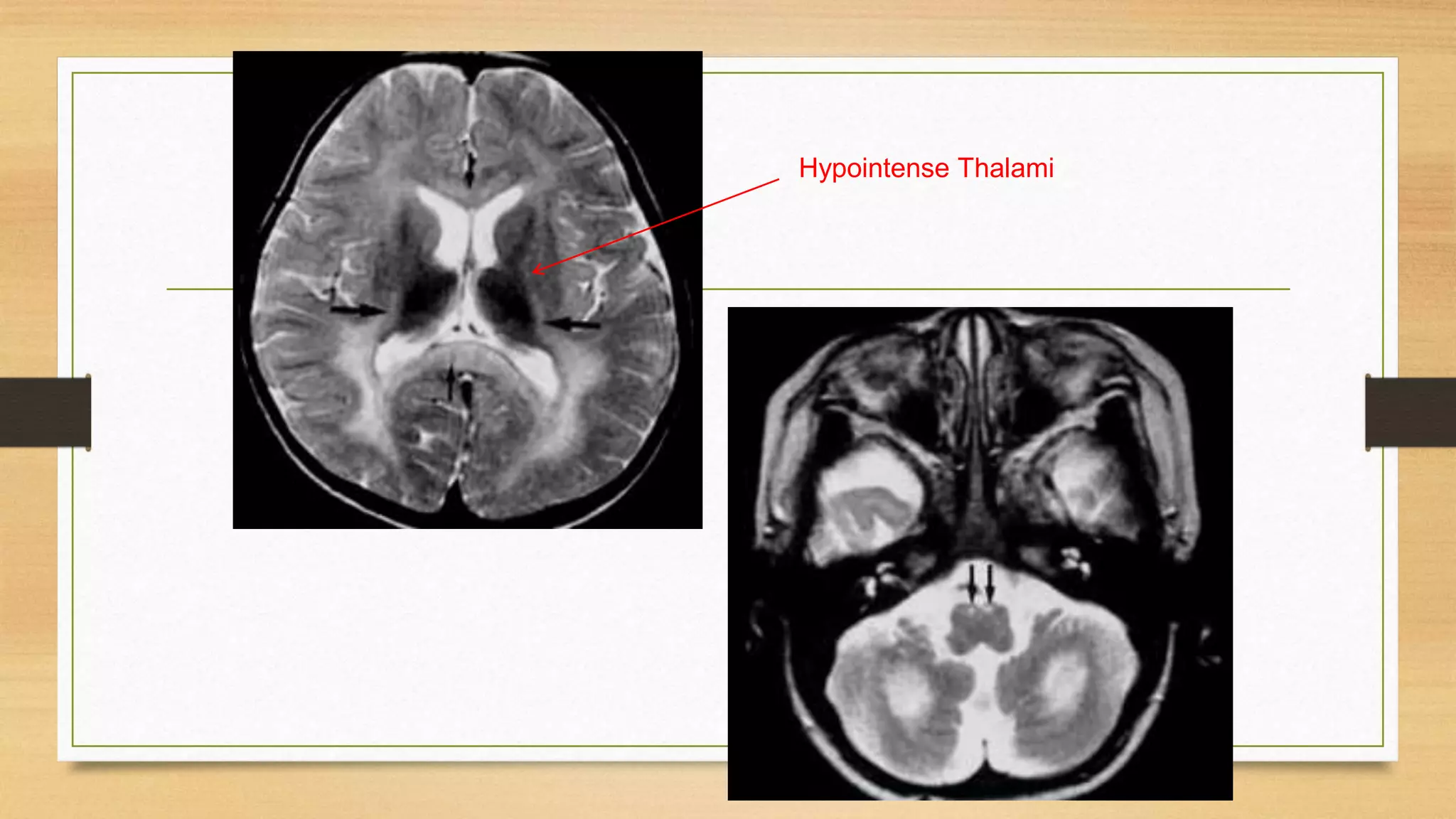 Hypointense Thalami
 