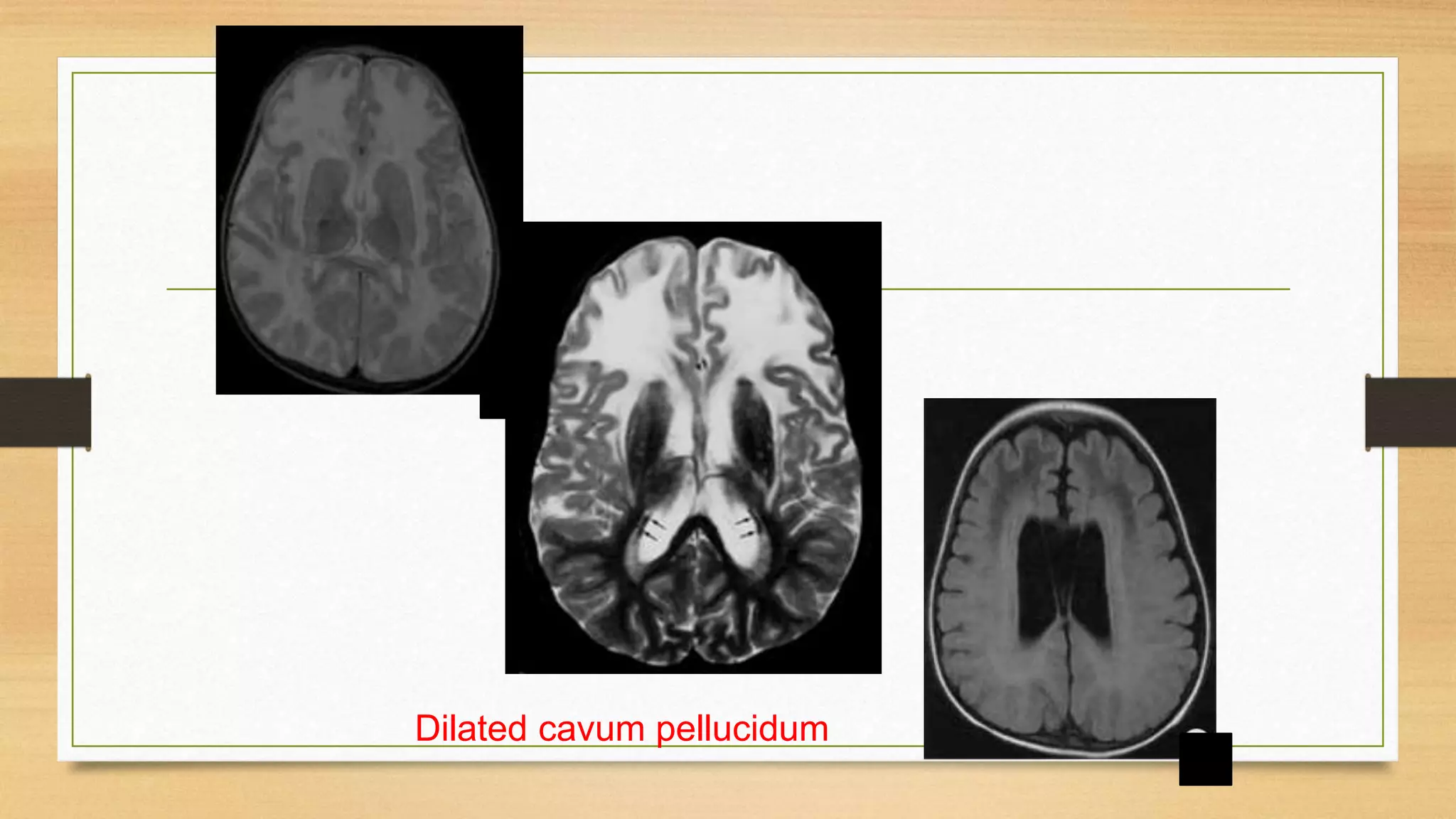 Dilated cavum pellucidum
 