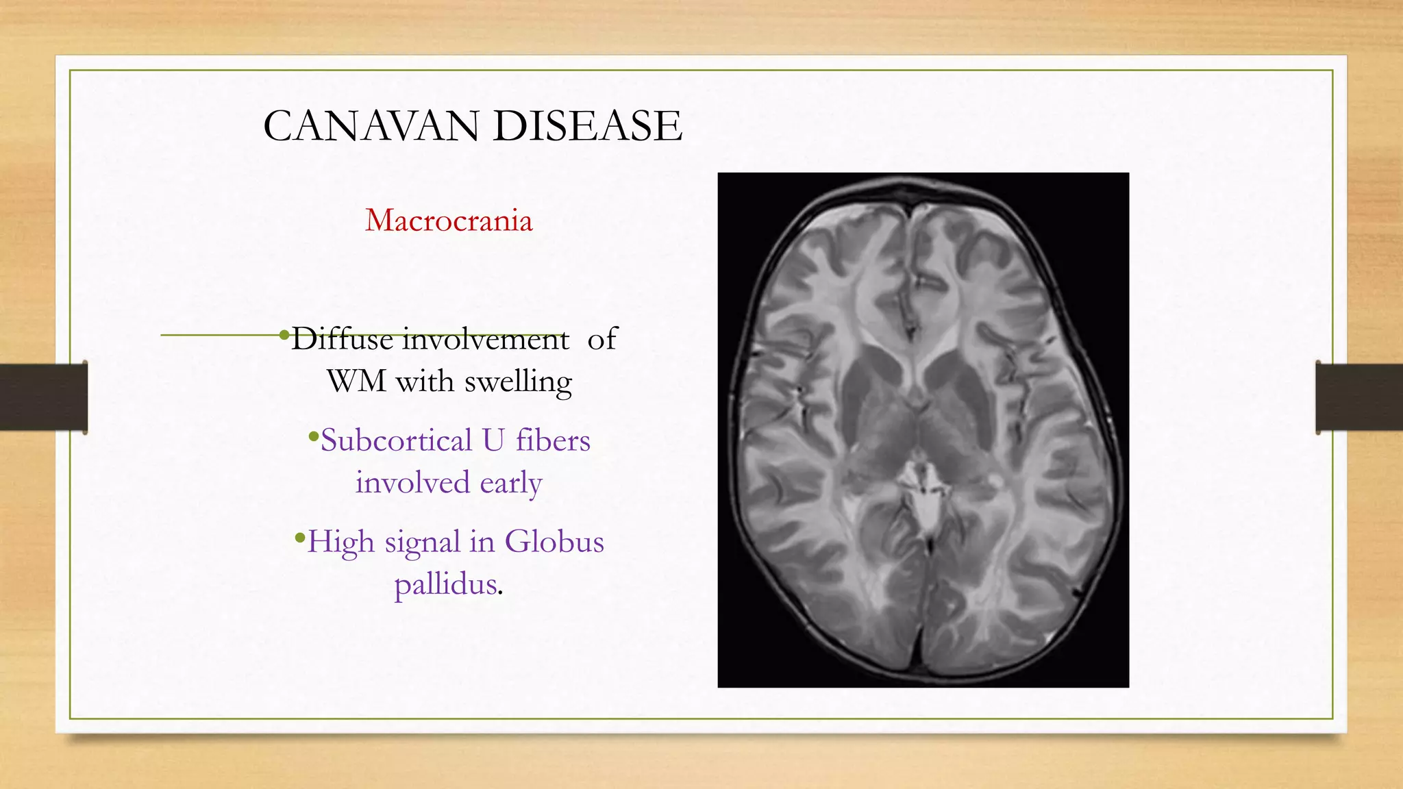 CANAVAN DISEASE
Macrocrania
•Diffuse involvement of
WM with swelling
•Subcortical U fibers
involved early
•High signal in Globus
pallidus.
 