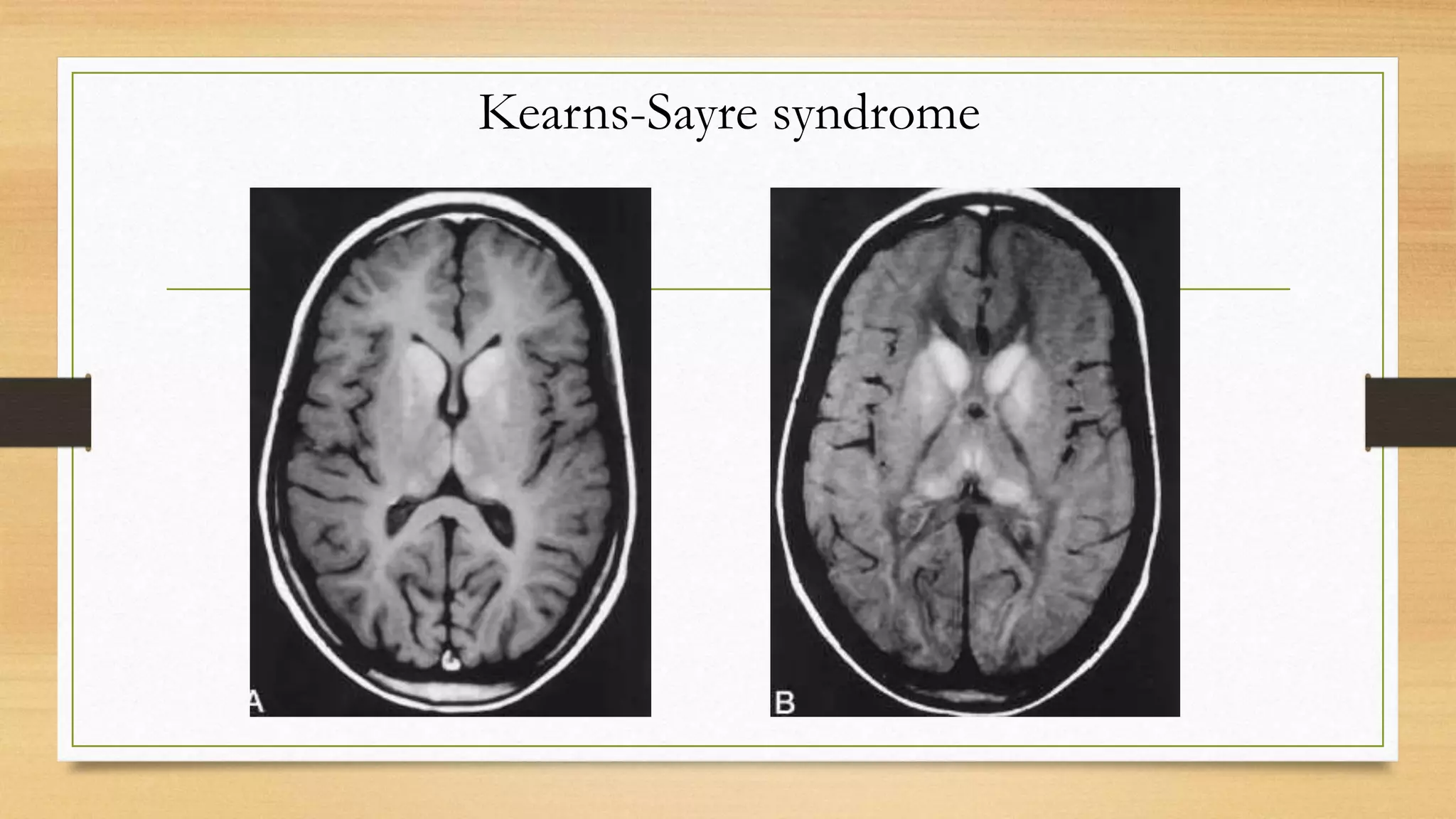 Kearns-Sayre syndrome
 