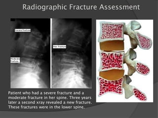 Patient who had a severe fracture and a
moderate fracture in her spine. Three years
later a second xray revealed a new fracture.
These fractures were in the lower spine.
Radiographic Fracture Assessment
 