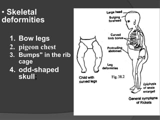 • Skeletal
deformities
1. Bow legs
2. pigeon chest
3. Bumps" in the rib
cage
4. odd-shaped
skull;
 