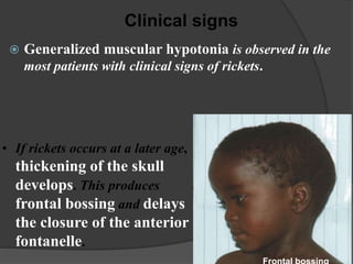  Generalized muscular hypotonia is observed in the
most patients with clinical signs of rickets.
Clinical signs
• If rickets occurs at a later age,
thickening of the skull
develops. This produces
frontal bossing and delays
the closure of the anterior
fontanelle.
 