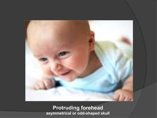 Protruding forehead
asymmetrical or odd-shaped skull
 