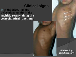 Clinical signs
 In the chest, knobby
deformities results in the
rachitic rosary along the
costochondral junctions.
Rib beading
(rachitic rosary)
 
